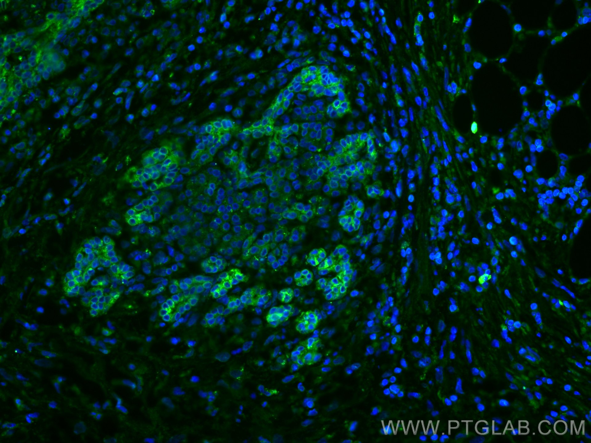 IF Staining of human pancreas cancer using 67990-1-Ig