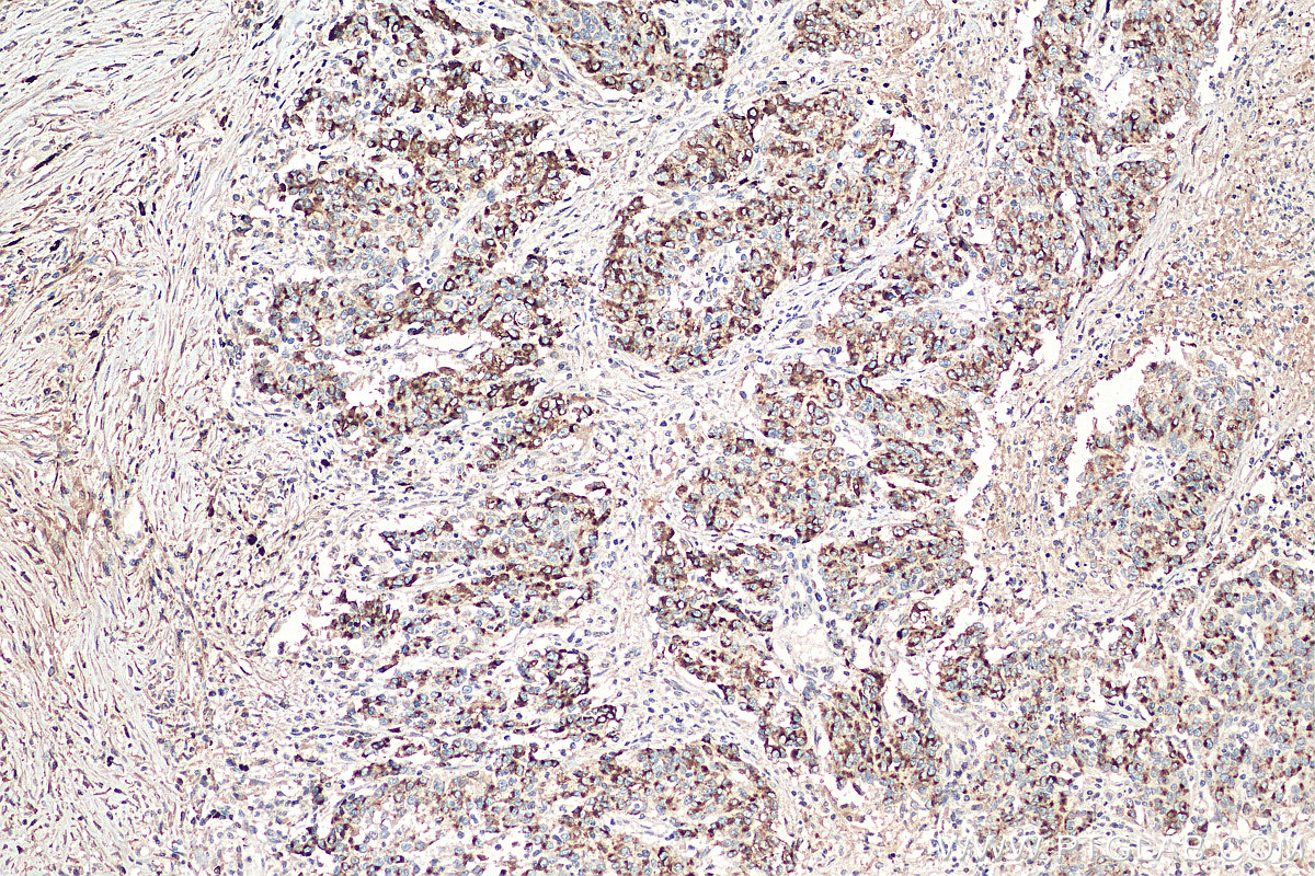 IHC staining of human stomach cancer using 67990-1-Ig (same clone as 67990-1-PBS)