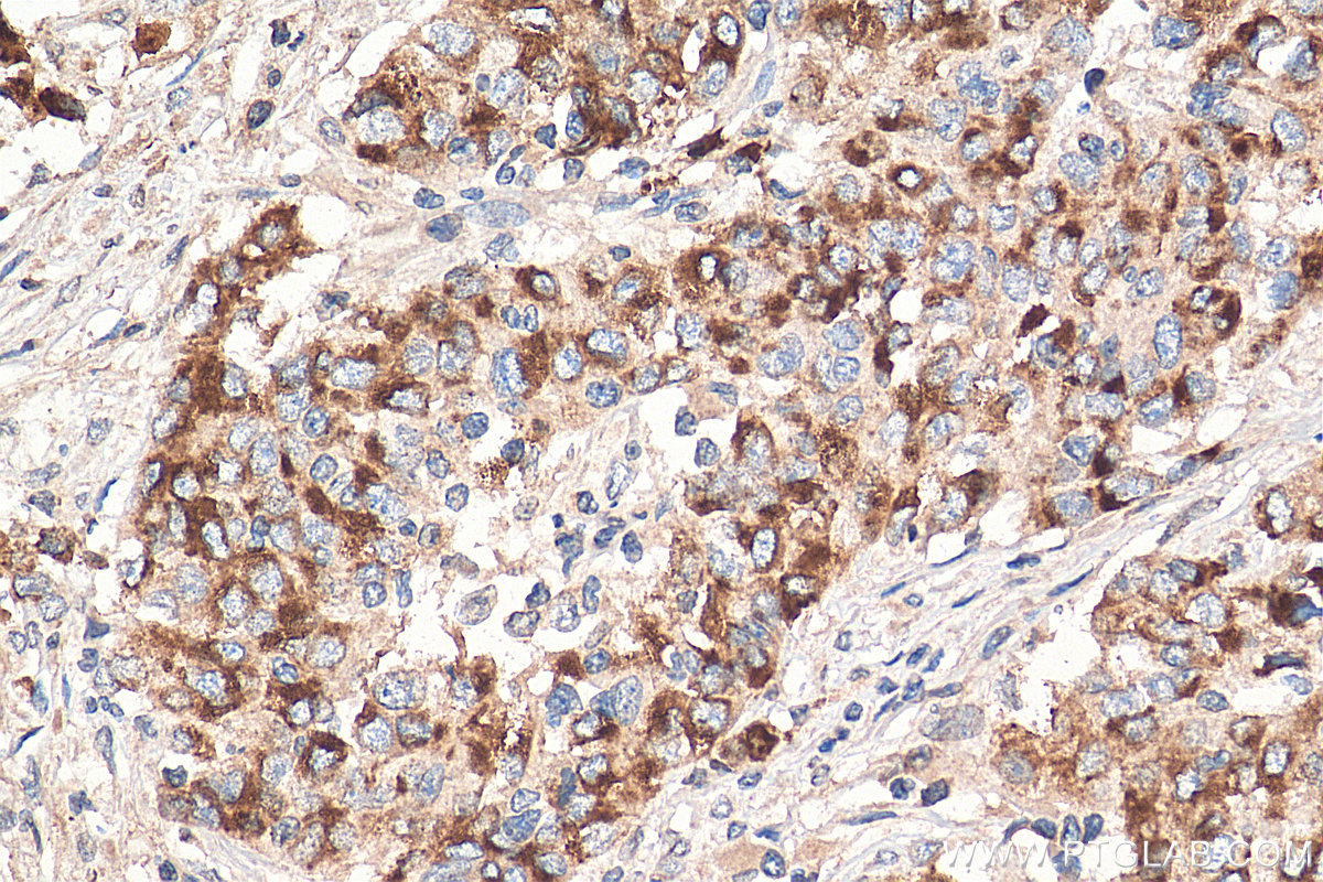 IHC staining of human stomach cancer using 67990-1-Ig (same clone as 67990-1-PBS)