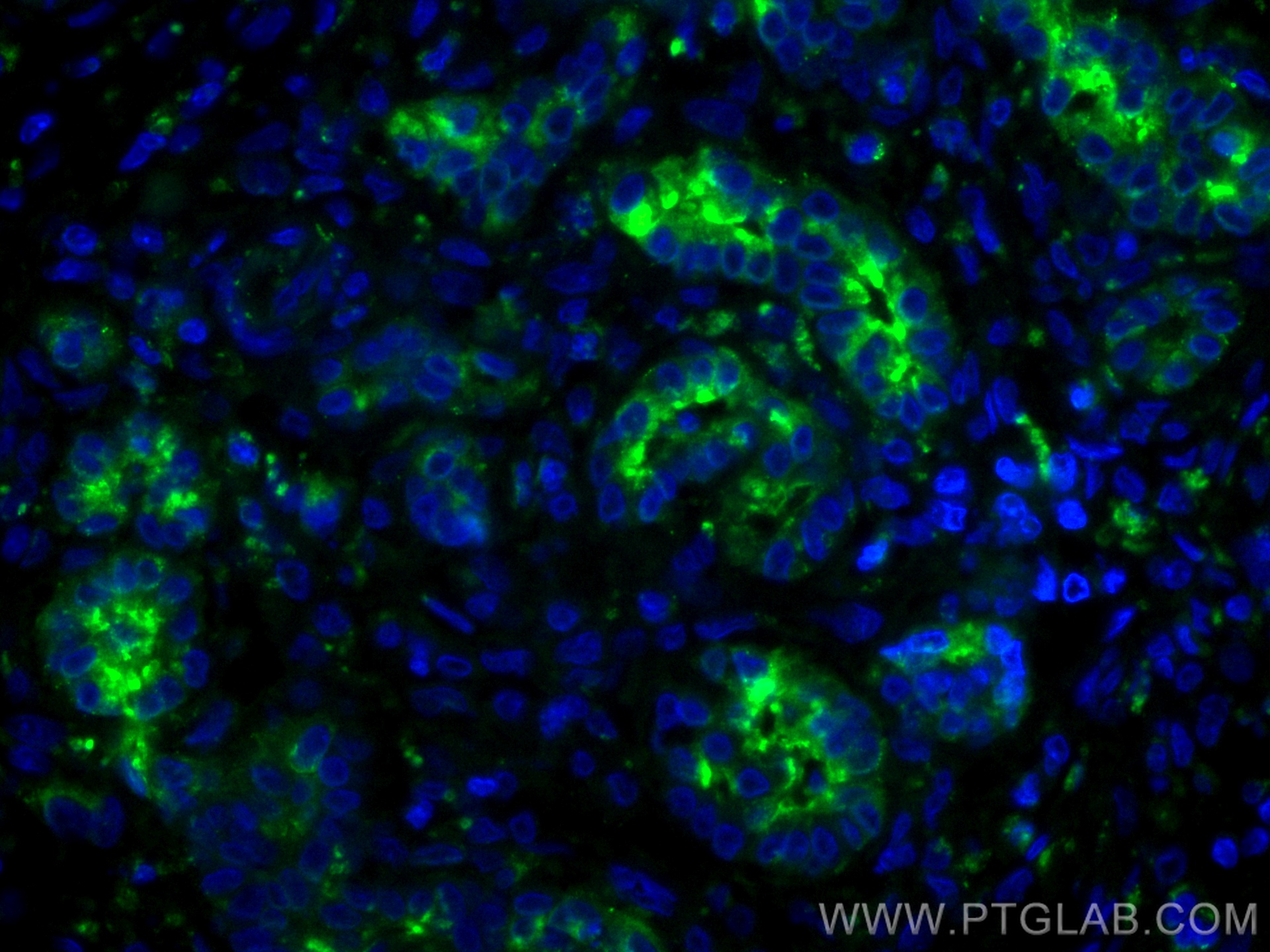 IF Staining of human pancreas cancer using CL488-67990