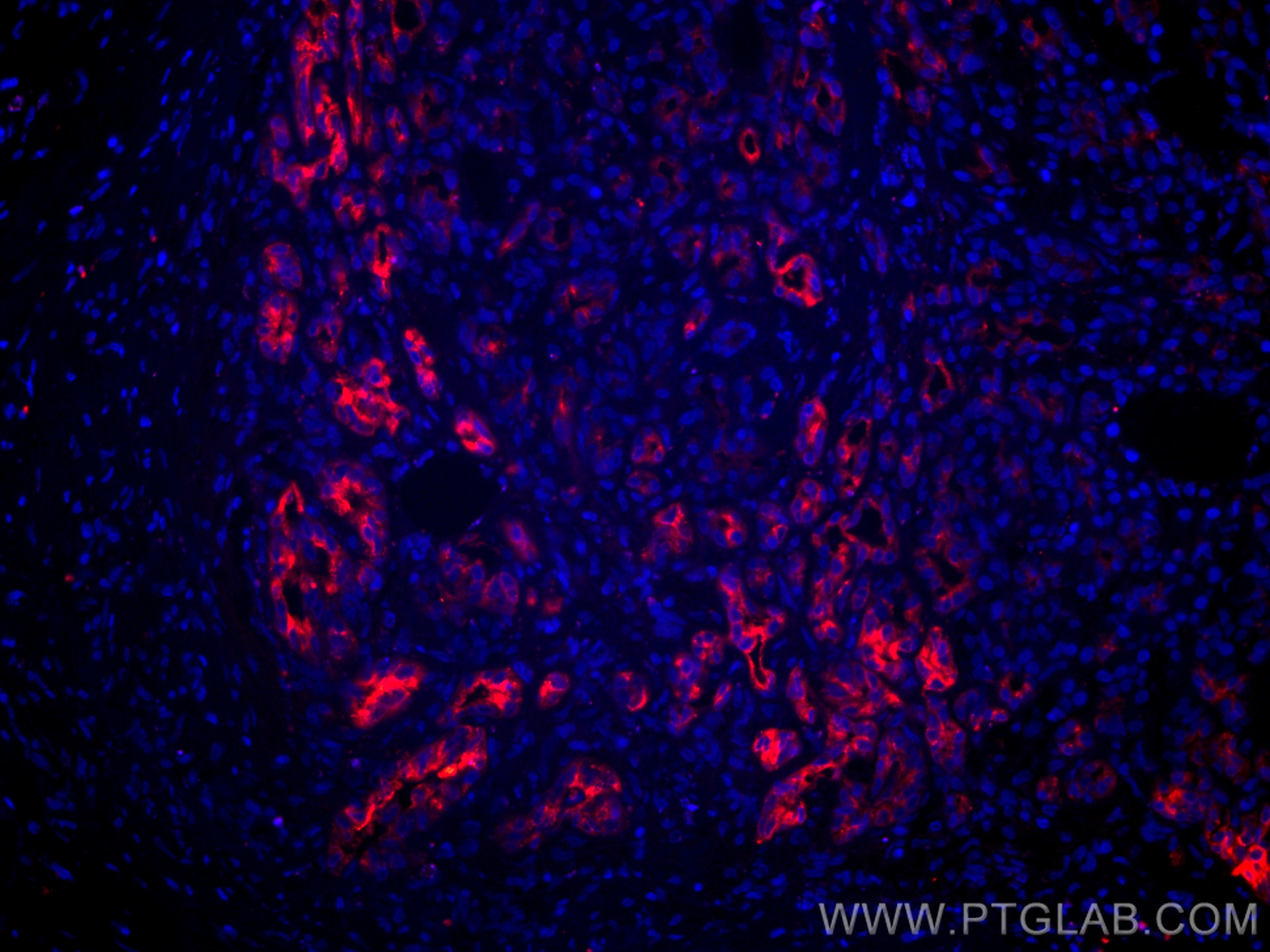 IF Staining of human pancreas cancer using CL594-67990