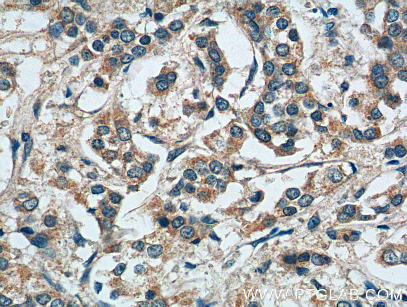 IHC staining of human breast cancer using 10375-2-AP