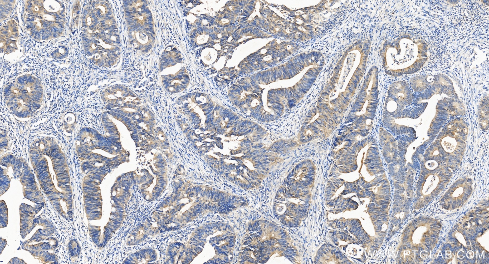 IHC staining of human colon cancer using 86551-3-RR