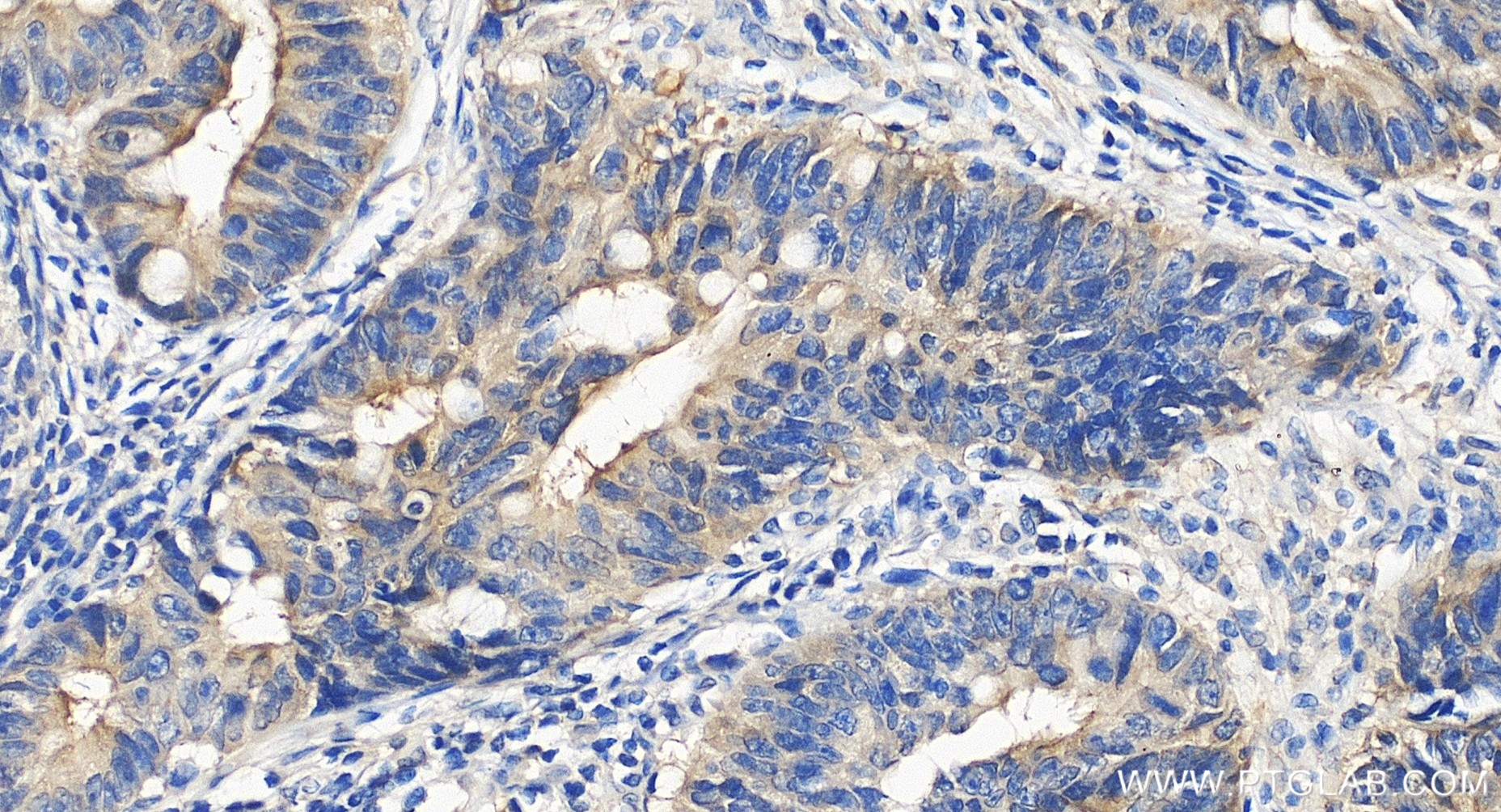 IHC staining of human colon cancer using 86551-3-RR