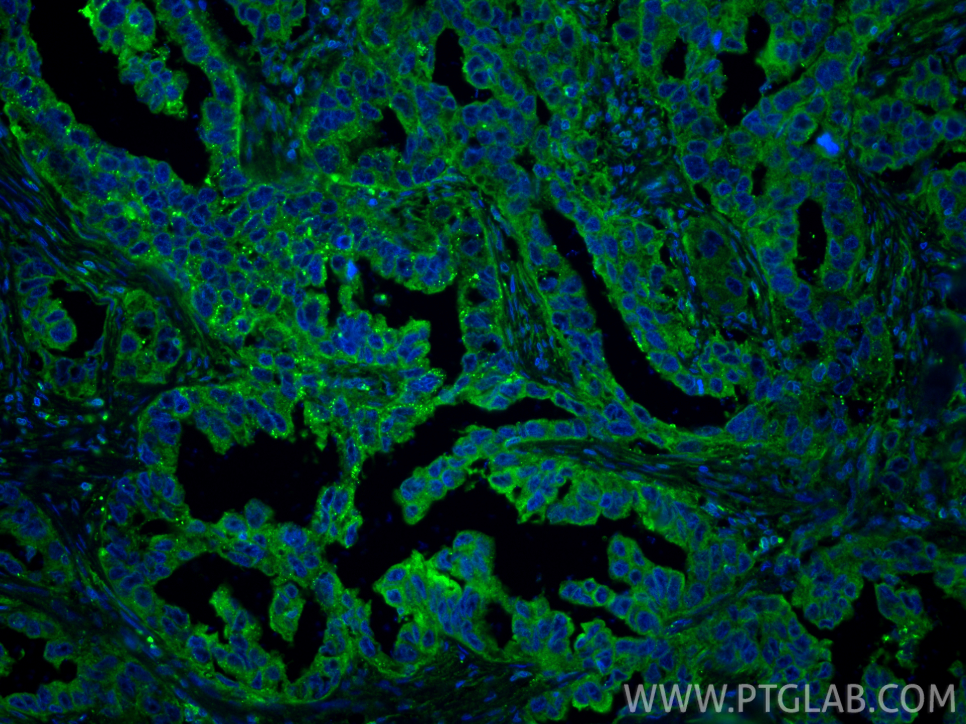 IF Staining of human colon cancer using 15886-1-AP