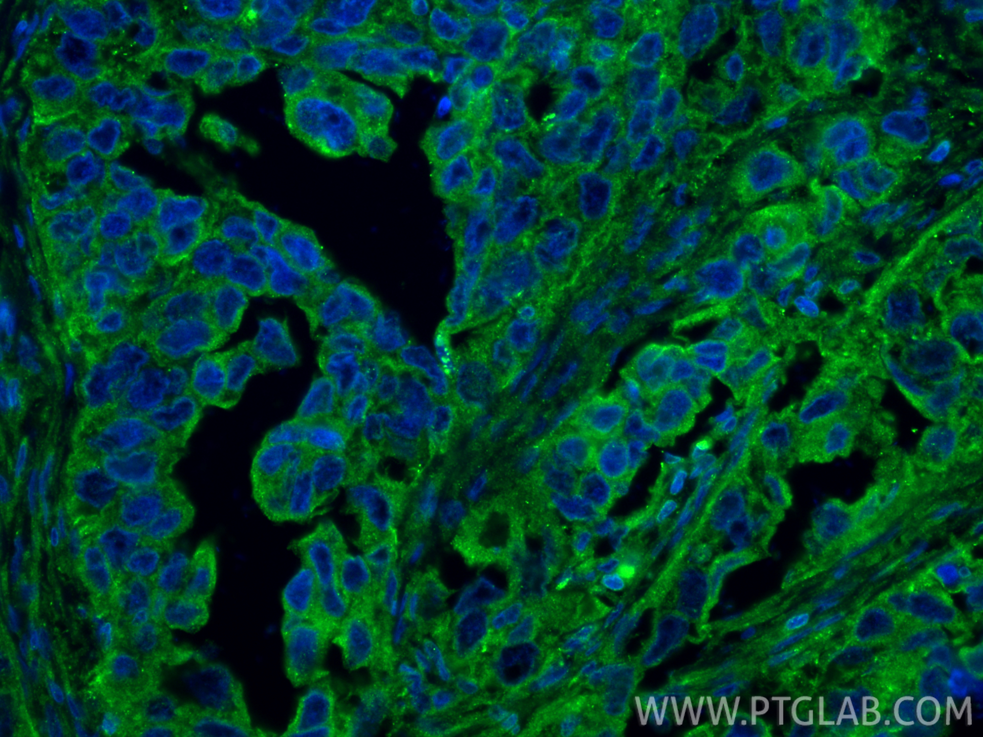 IF Staining of human colon cancer using 15886-1-AP