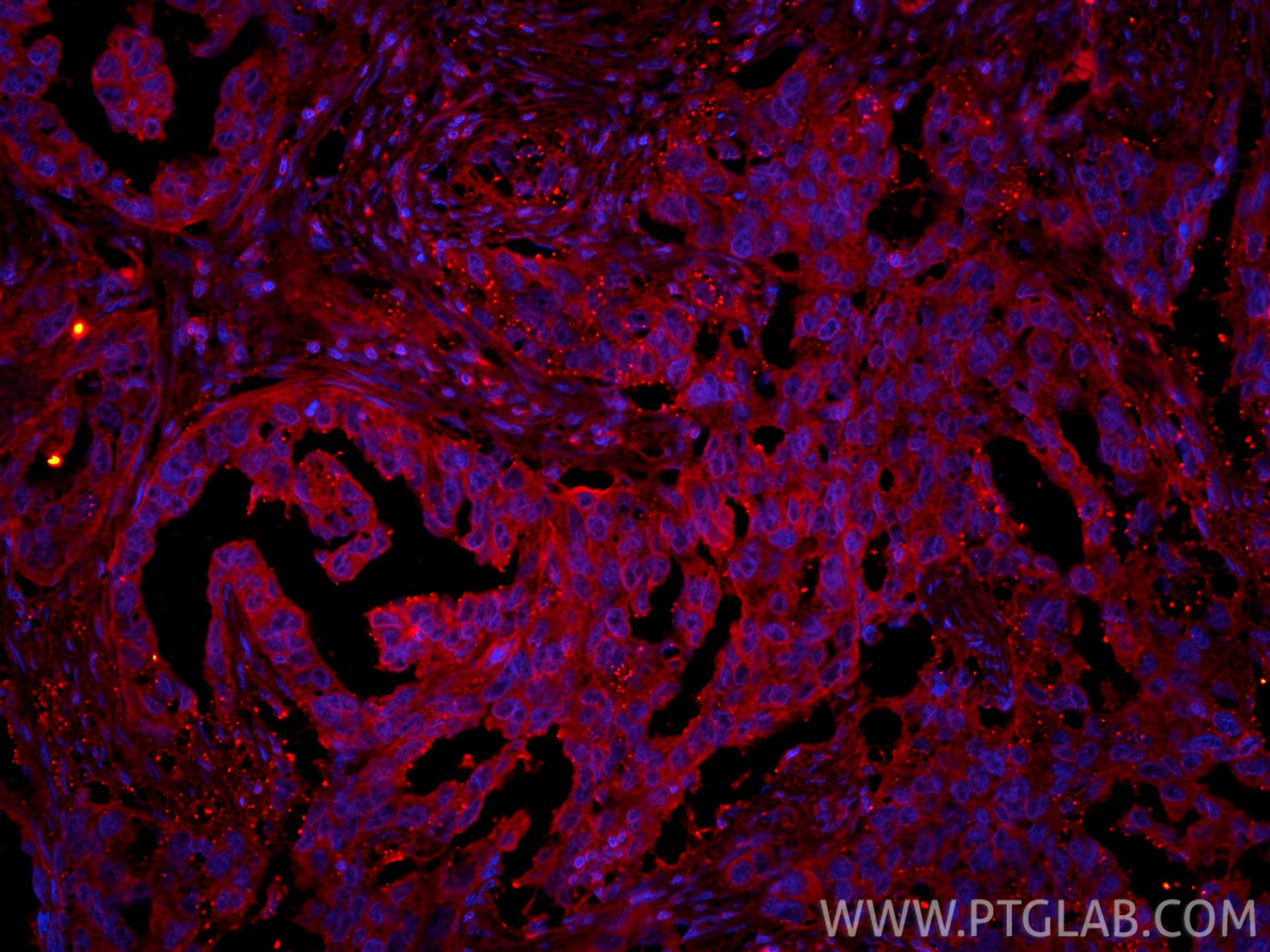 IF Staining of human colon cancer using CL594-15886 IF Staining of human colon cancer using CL594-15886