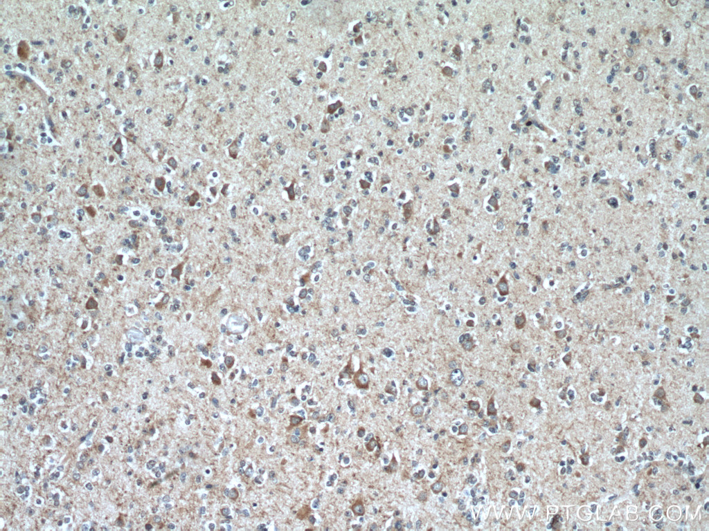 IHC staining of human gliomas using 12472-1-AP