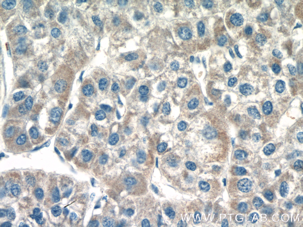 IHC staining of human liver cancer using 27501-1-AP