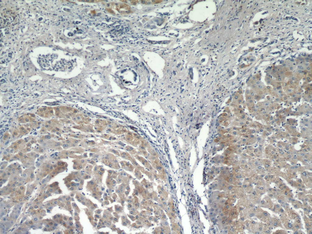 IHC staining of human hepatocirrhosis using 21573-1-AP