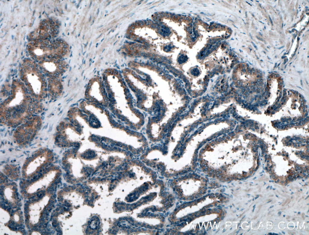 IHC staining of human prostate hyperplasia using 10370-1-AP (same clone as 10370-1-PBS)