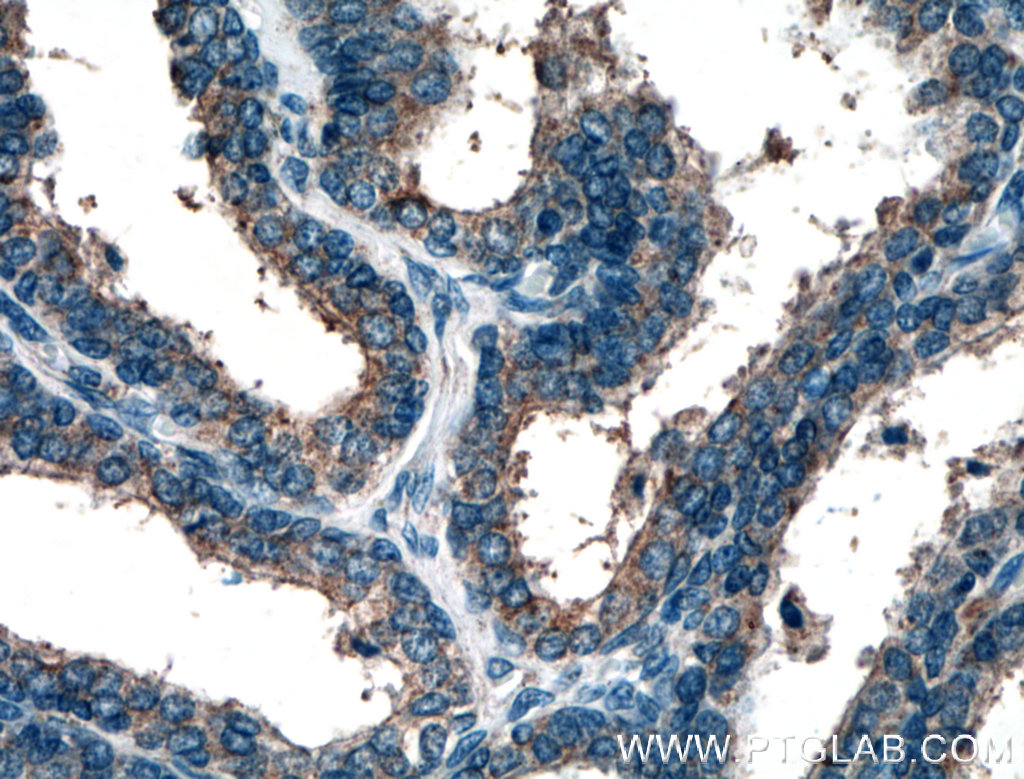 IHC staining of human prostate hyperplasia using 10370-1-AP (same clone as 10370-1-PBS)