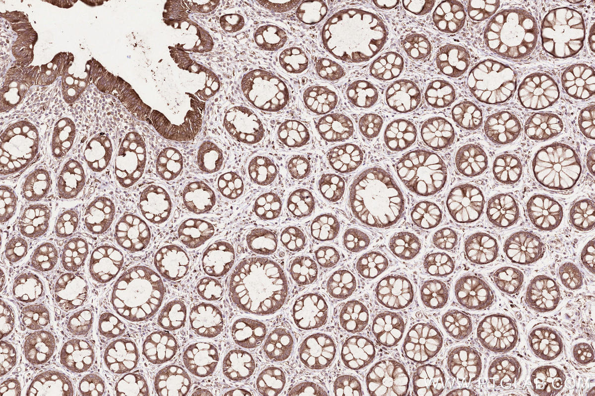 IHC staining of human rectal cancer using 23960-1-AP IHC staining of human rectal cancer using 23960-1-AP