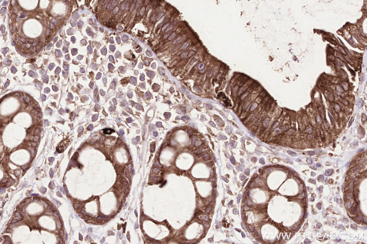 IHC staining of human rectal cancer using 23960-1-AP IHC staining of human rectal cancer using 23960-1-AP