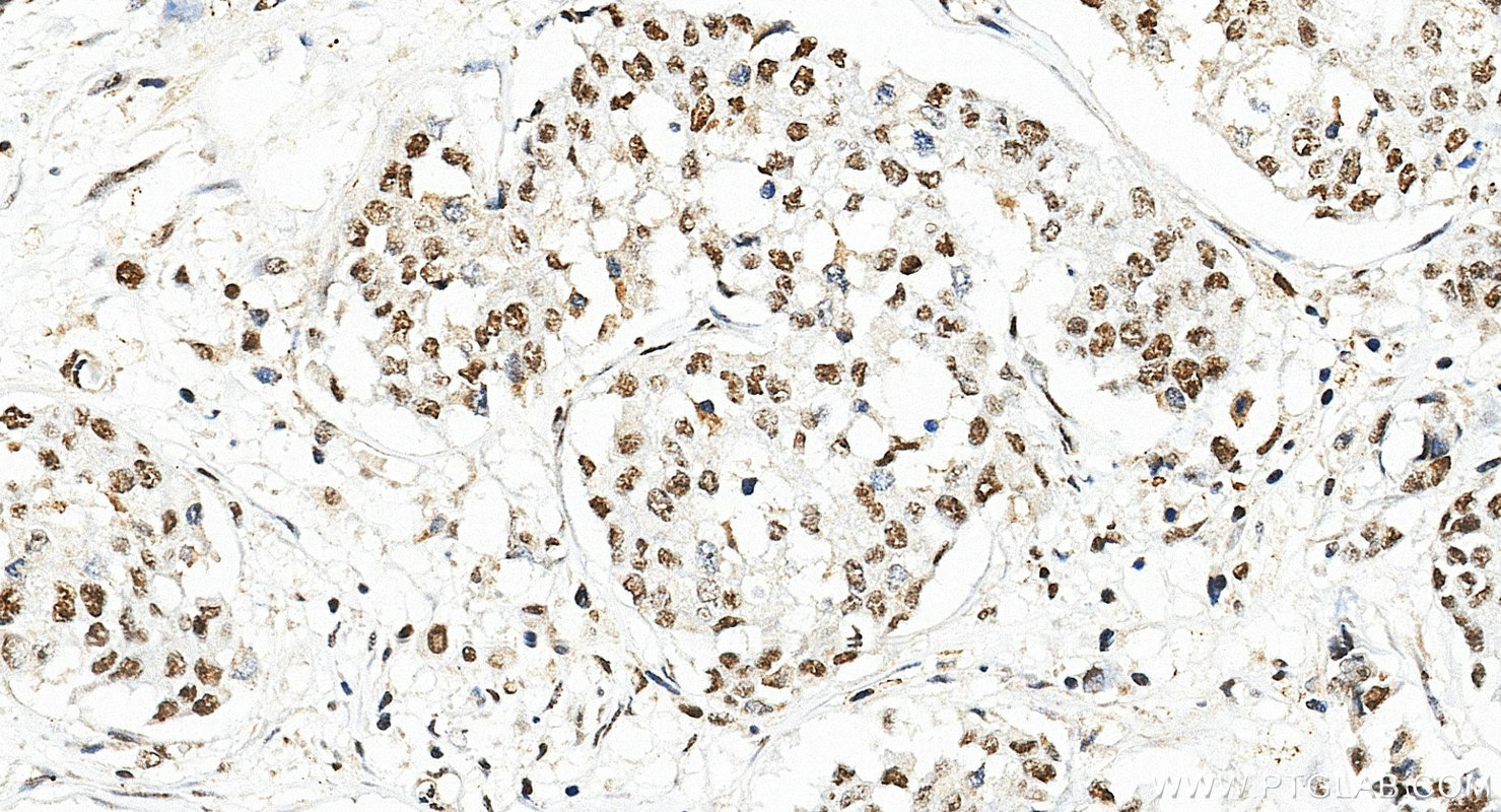 IHC staining of human breast cancer using 10695-1-AP (same clone as 10695-1-PBS)