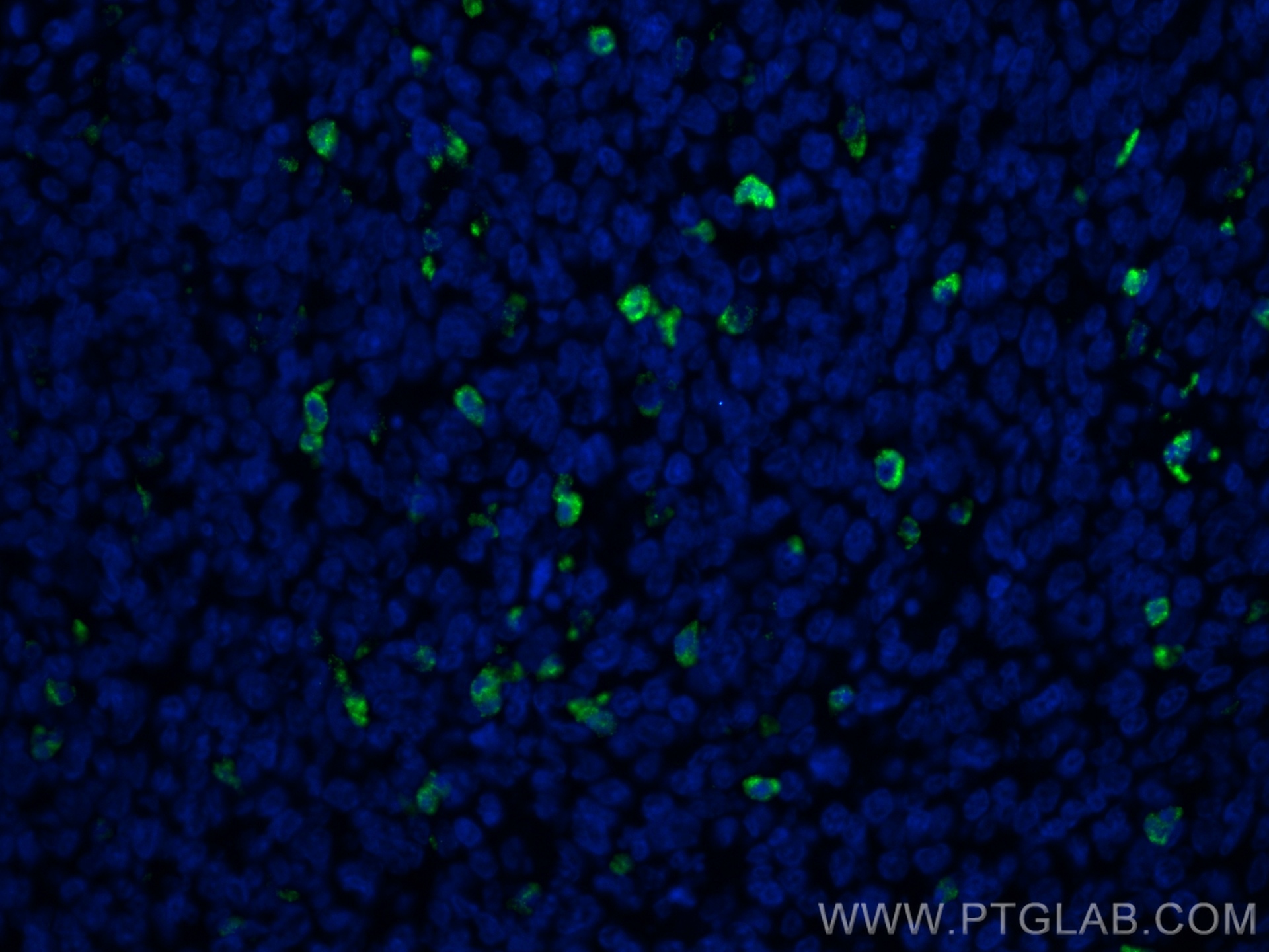 IF Staining of human tonsillitis using 22225-1-AP