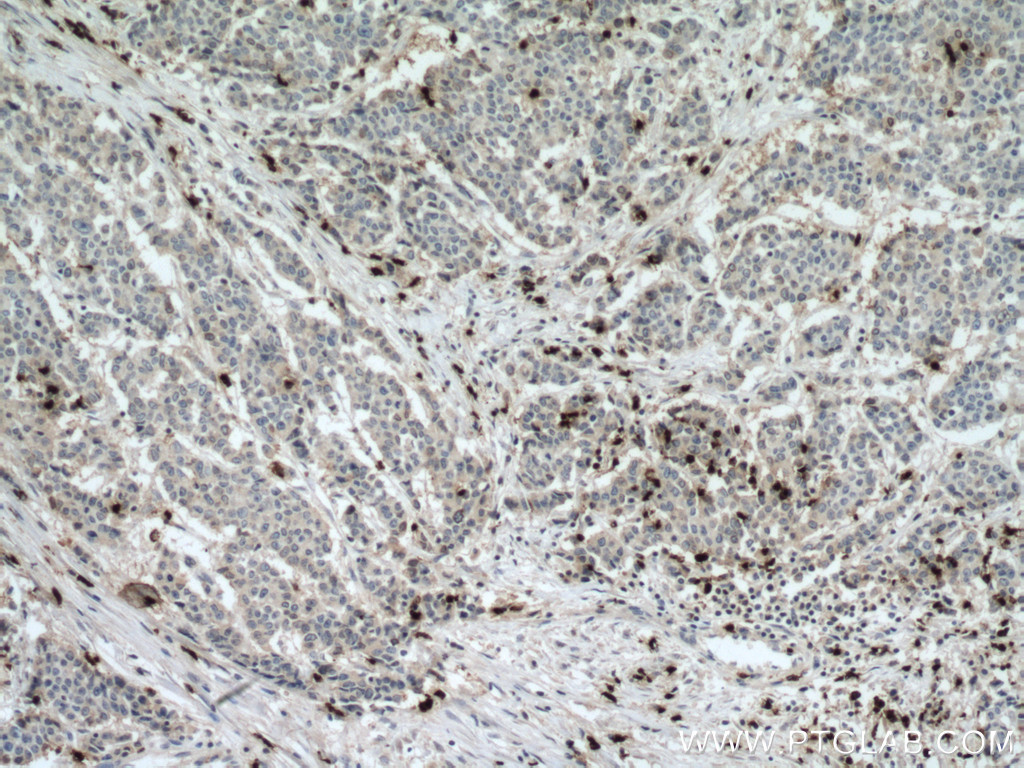 IHC staining of human colon cancer using 22225-1-AP