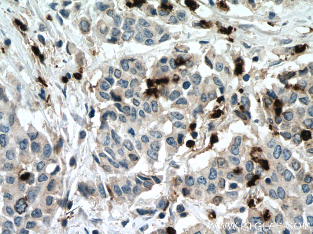 IHC staining of human colon cancer using 22225-1-AP