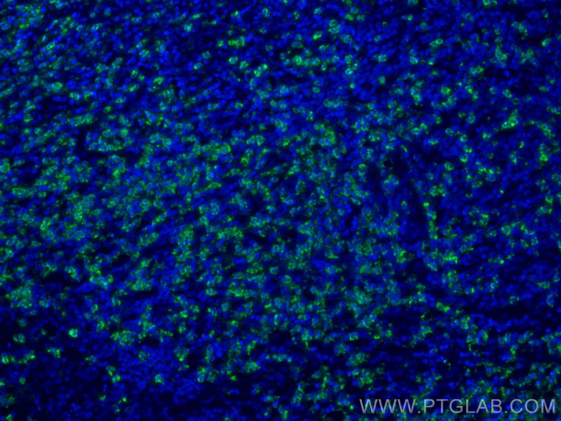 IF Staining of human appendicitis using 66177-1-Ig