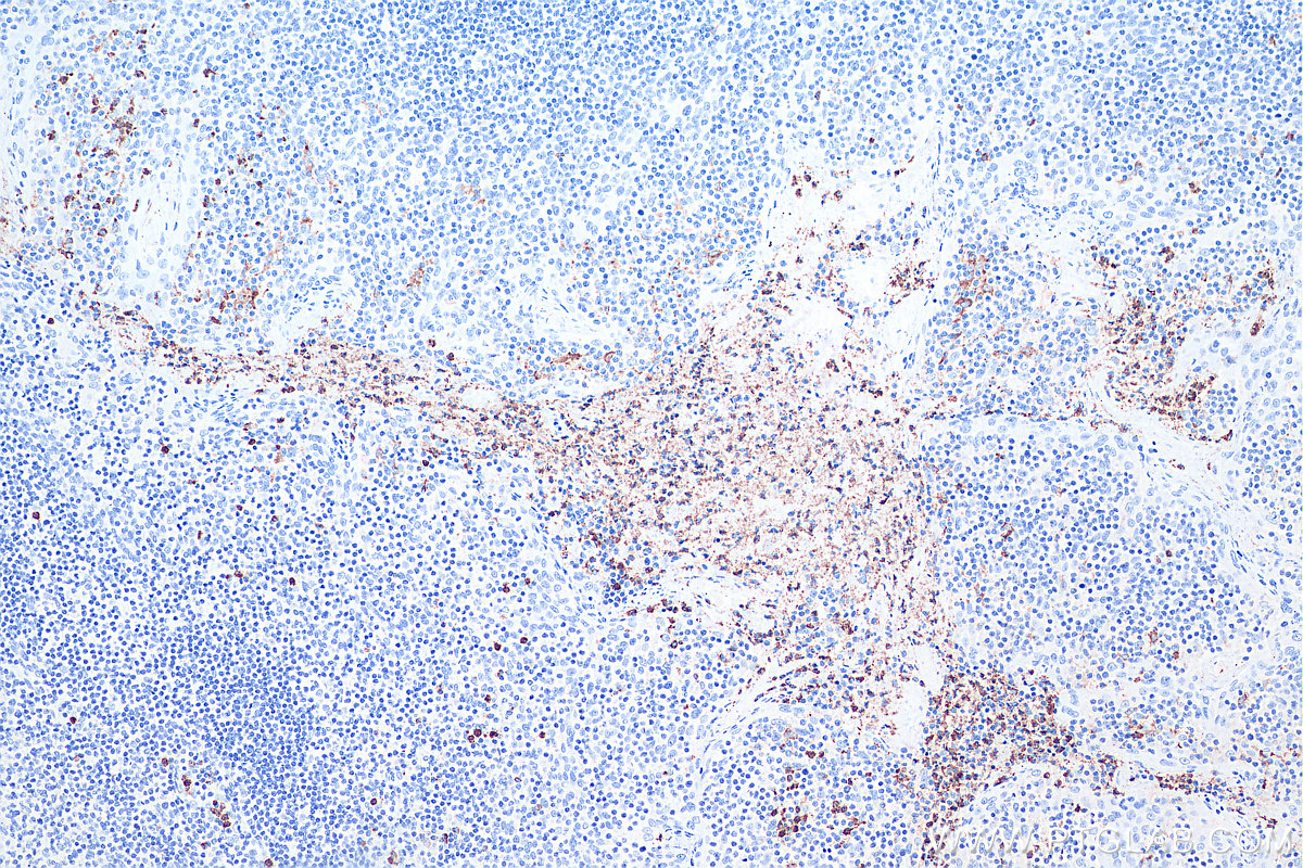 IHC staining of human tonsillitis using 66177-1-Ig IHC staining of human tonsillitis using 66177-1-Ig