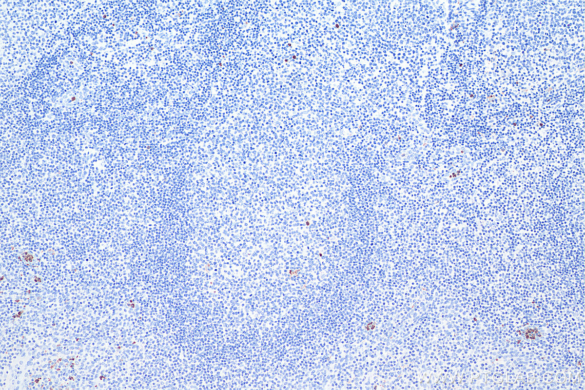 IHC staining of human tonsillitis using 66177-1-Ig IHC staining of human tonsillitis using 66177-1-Ig