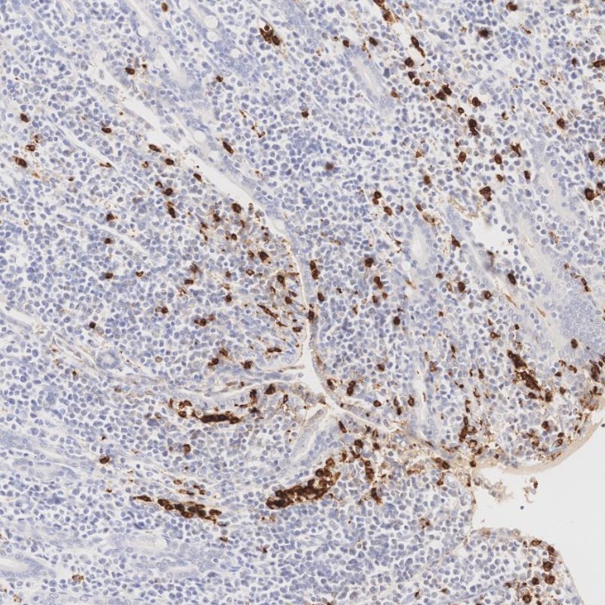 IHC staining of human lymphoma using 81610-1-RR