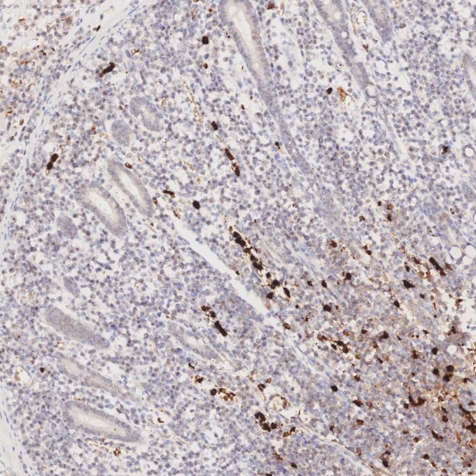 IHC staining of human lymphoma using 81610-1-RR