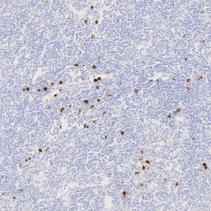 IHC staining of human lymphoma using 81610-1-RR