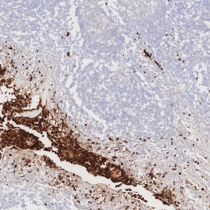 IHC staining of human tonsillitis using 81610-1-RR