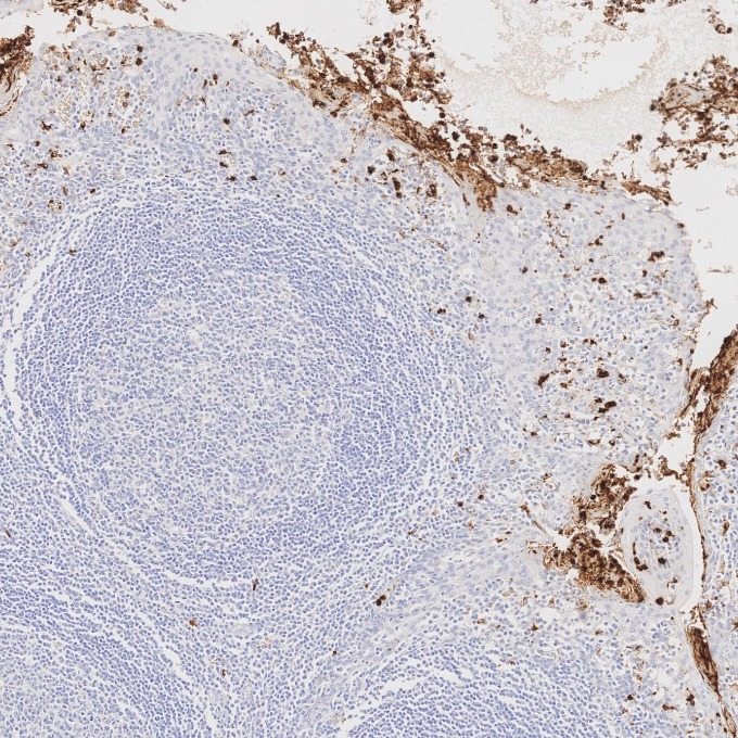 IHC staining of human tonsillitis using 81610-1-RR