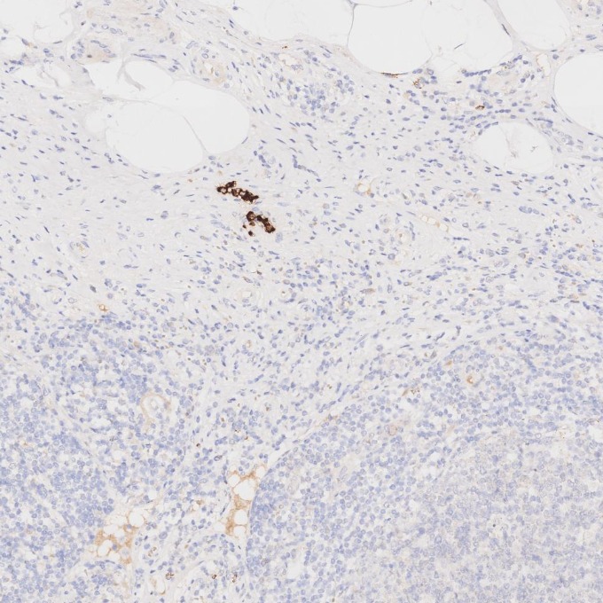 IHC staining of human appendicitis using 81610-1-RR