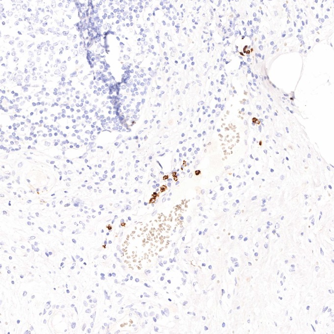 IHC staining of human appendicitis using 81610-1-RR