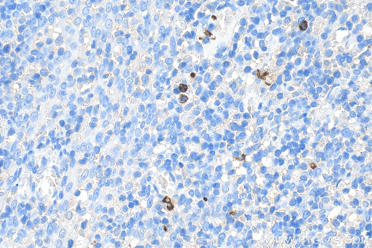 IHC staining of human tonsillitis using Biotin-66177