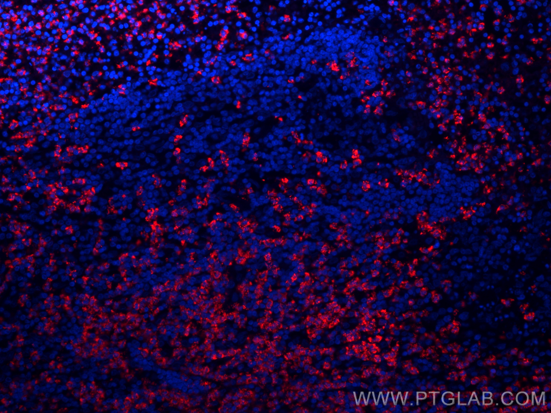 IF Staining of human appendicitis using CL594-66177