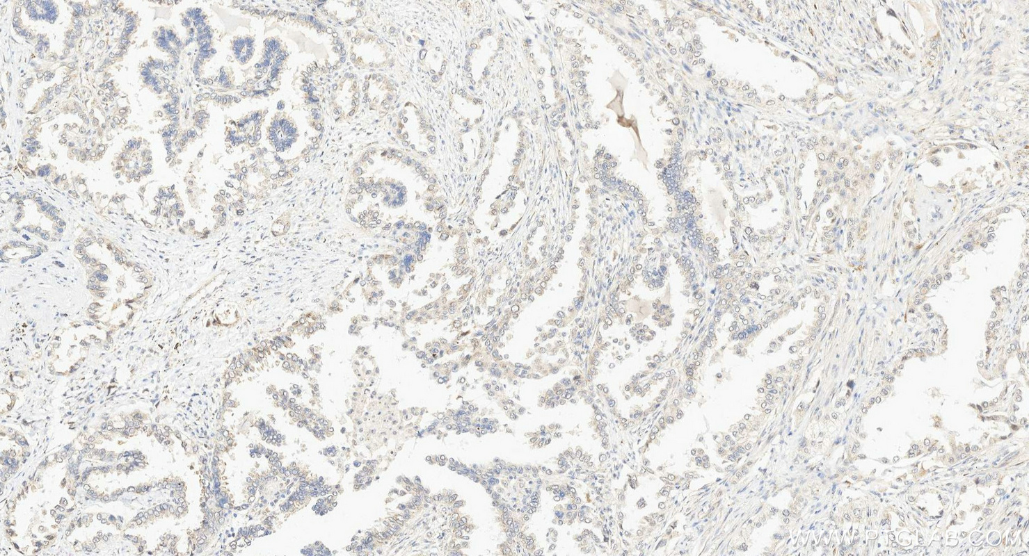 IHC staining of human lung cancer using 14650-1-AP
