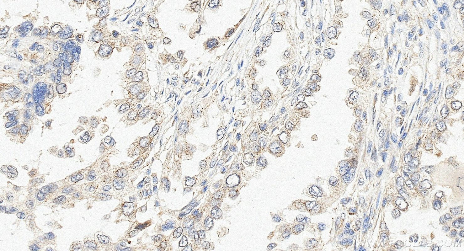 IHC staining of human lung cancer using 14650-1-AP