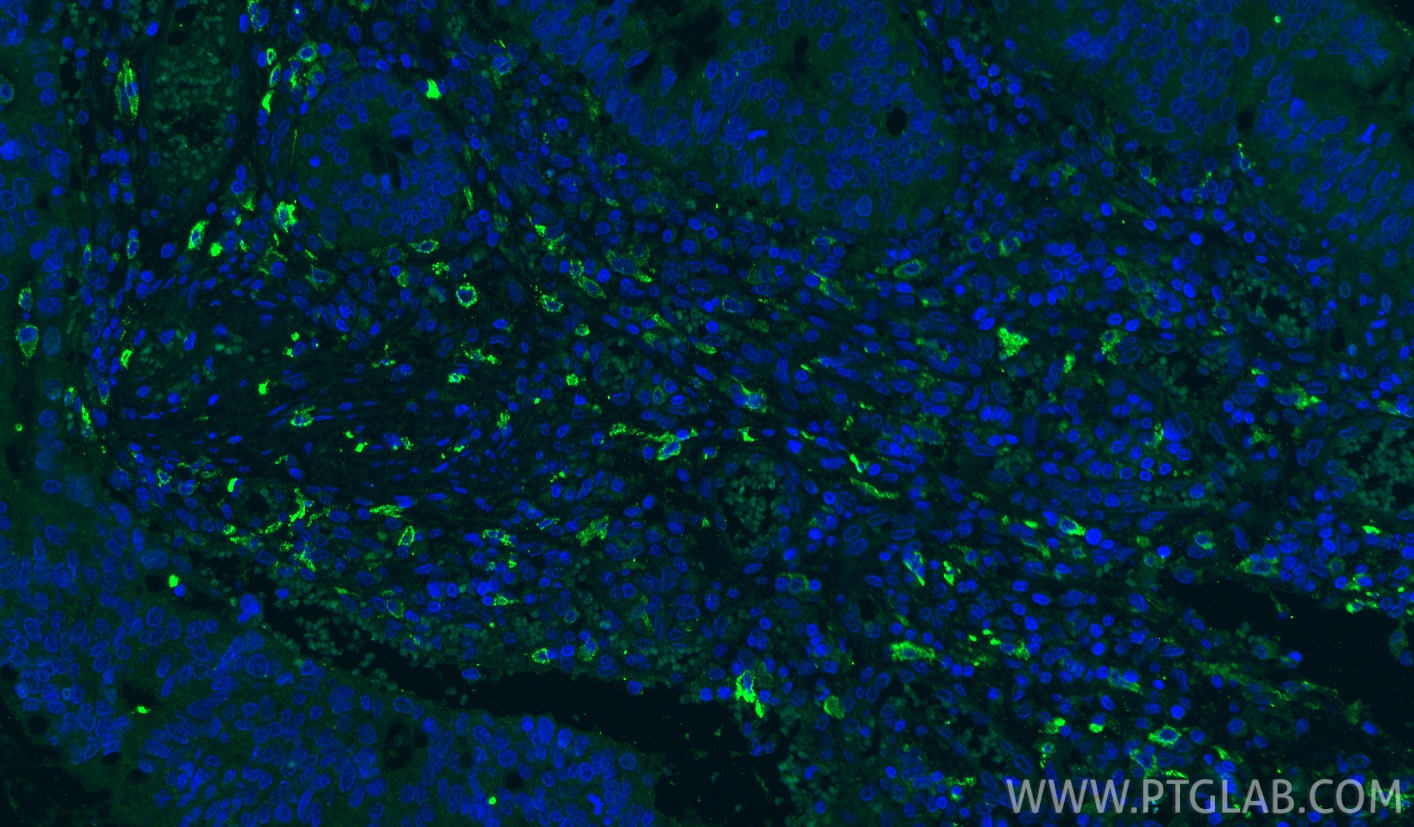 IF Staining of human colon cancer using 60143-1-Ig