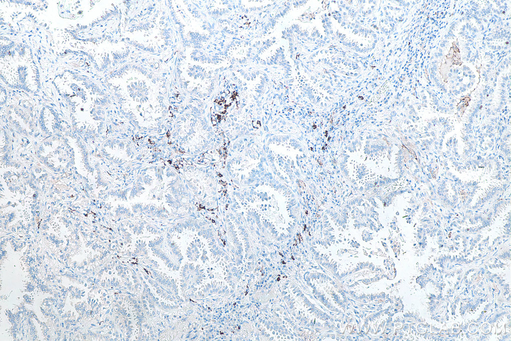 IHC staining of human lung cancer using 60143-1-Ig IHC staining of human lung cancer using 60143-1-Ig
