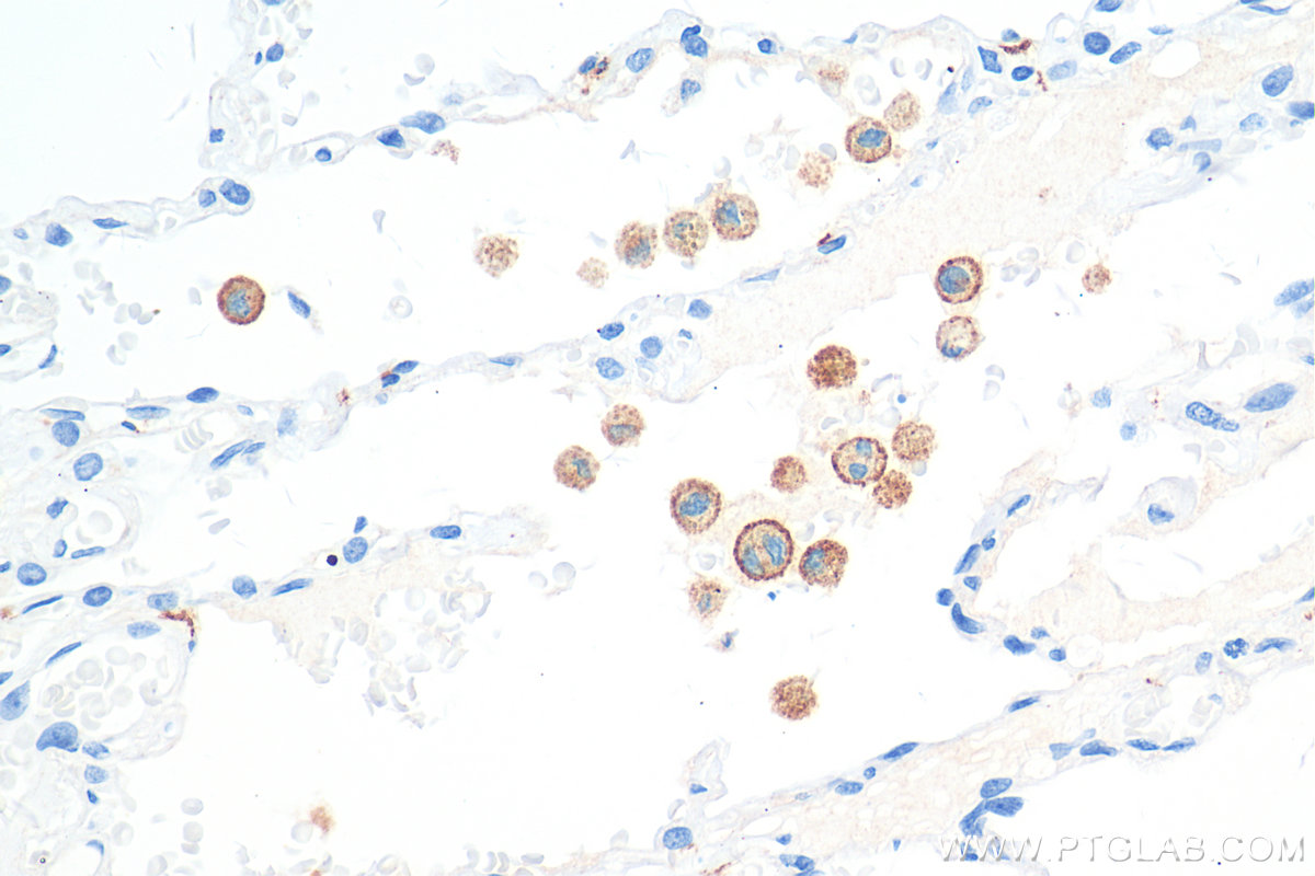 IHC staining of human lung cancer using 81525-1-RR