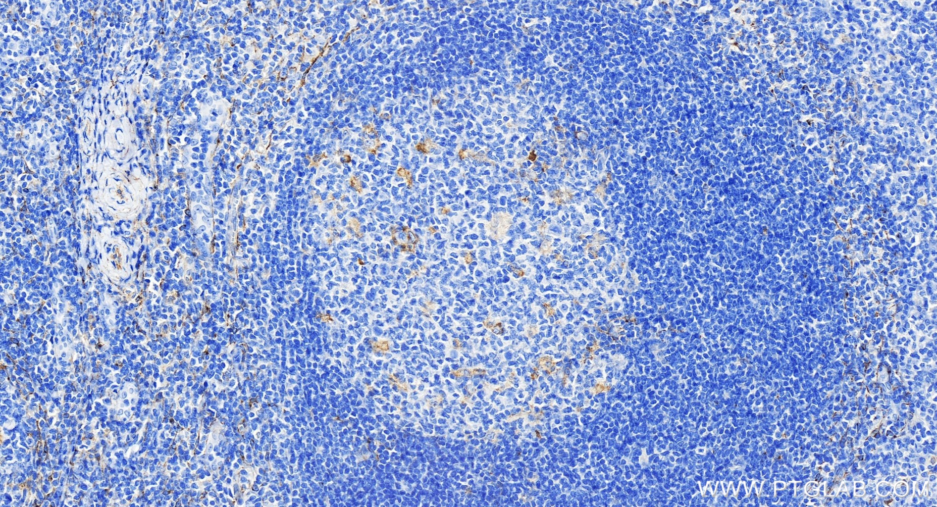 IHC staining of human tonsillitis using 86028-1-RR