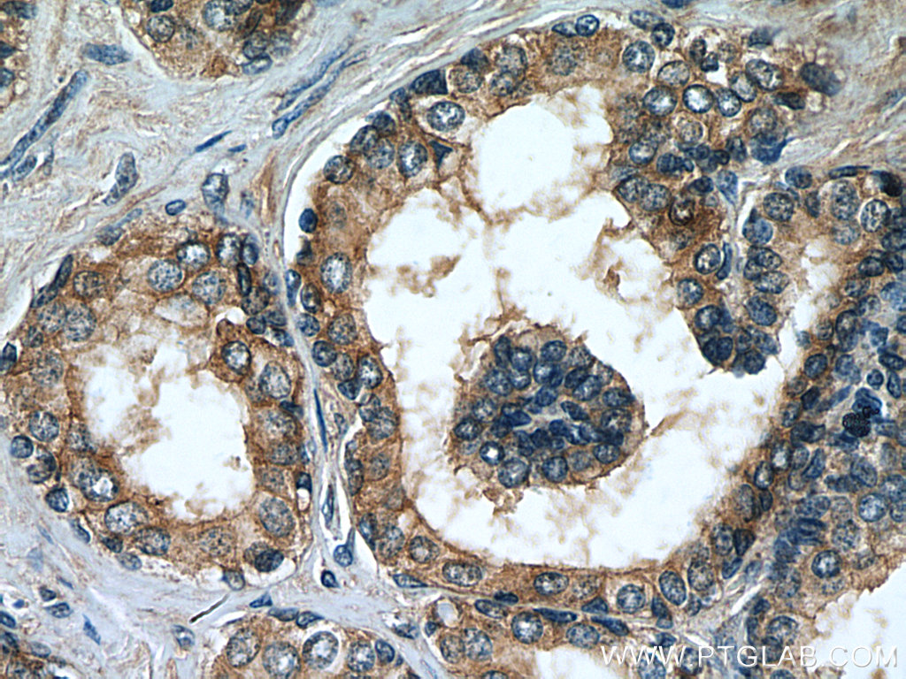 IHC staining of human prostate hyperplasia using 67230-1-Ig