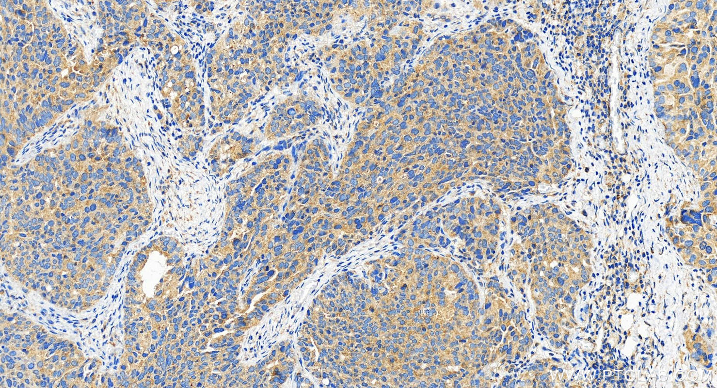 IHC staining of human ovary cancer using 29792-1-AP