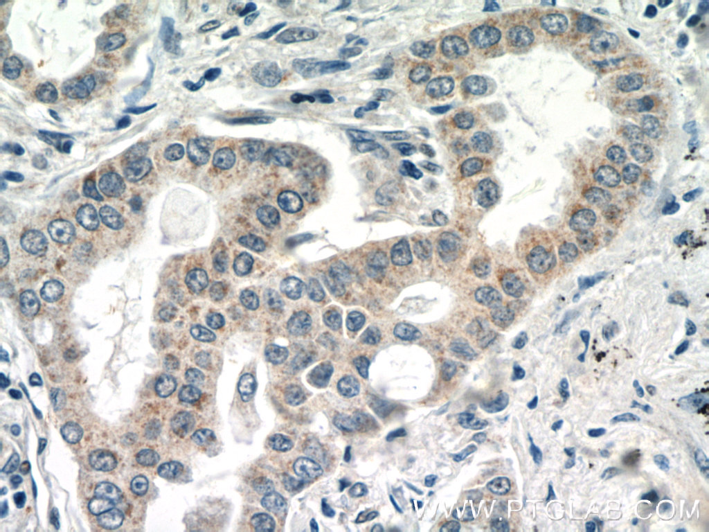 IHC staining of human lung cancer using 16254-1-AP