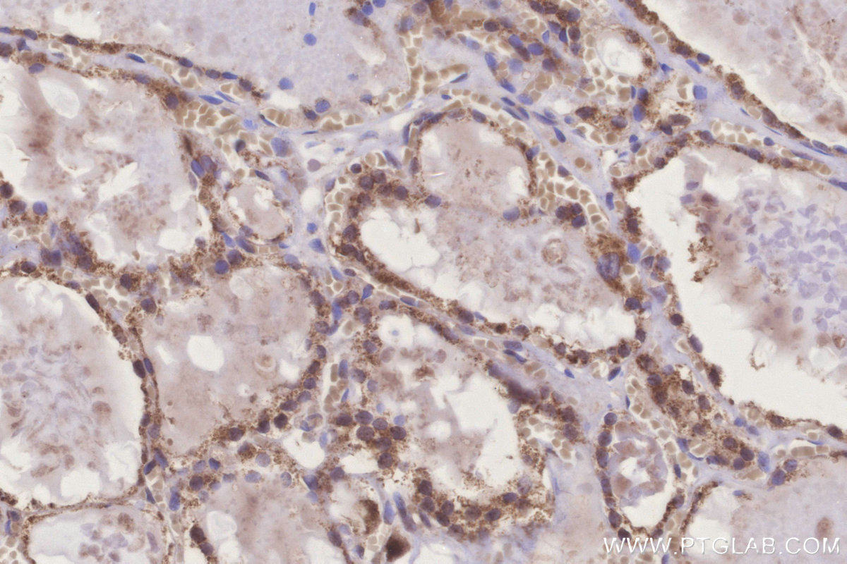 IHC staining of human thyroid cancer using 16652-1-AP IHC staining of human thyroid cancer using 16652-1-AP