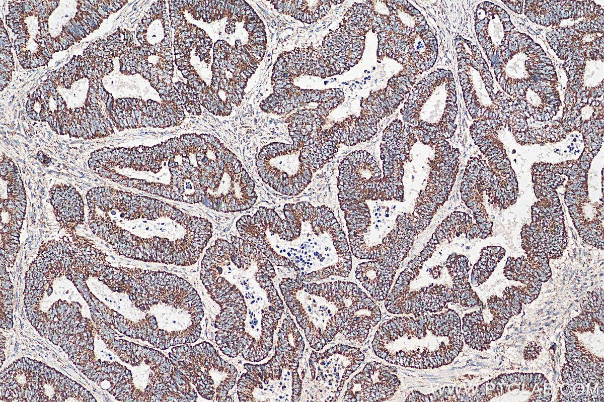 IHC staining of human colon cancer using 14795-1-AP