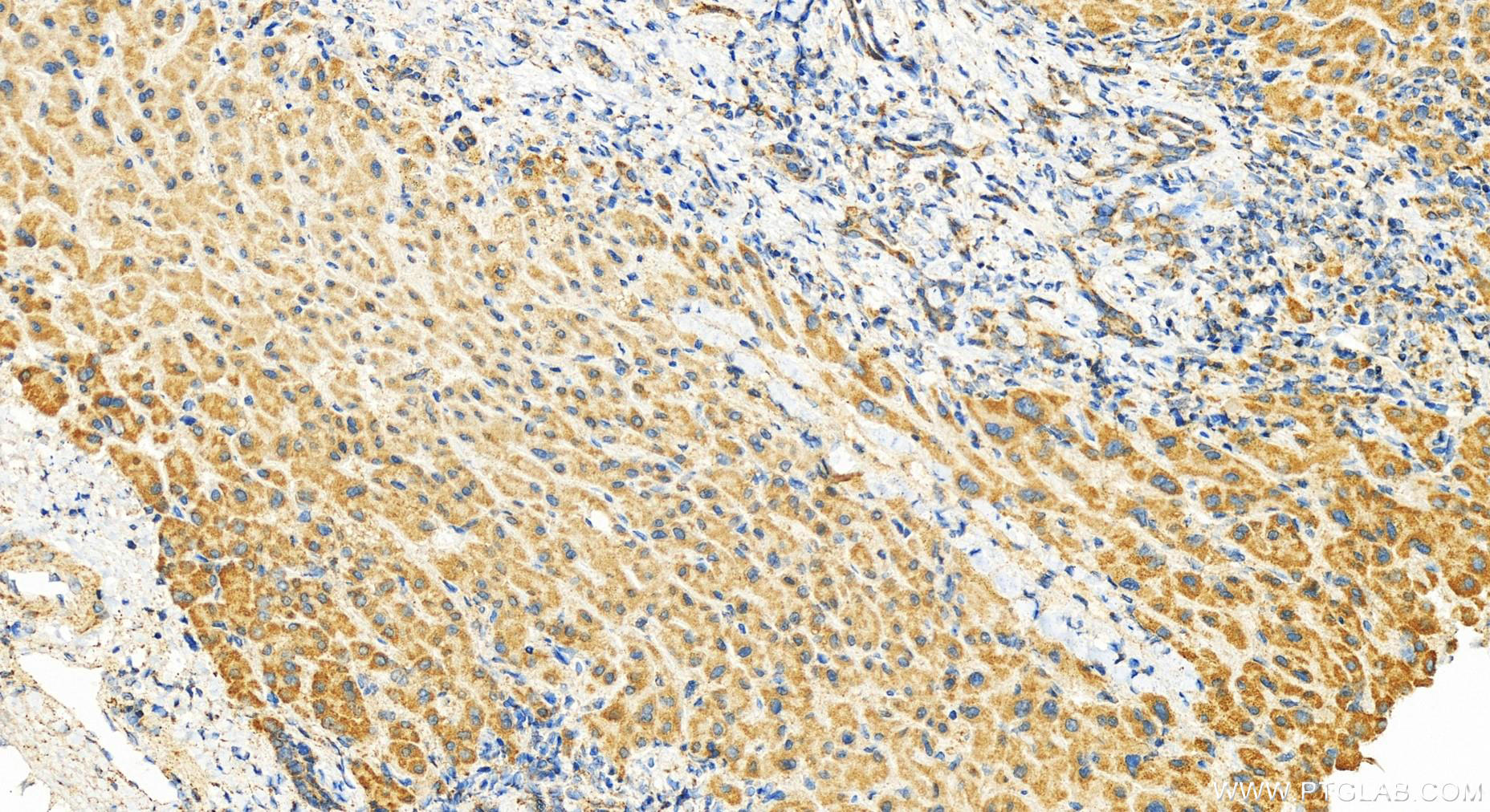 IHC staining of human intrahepatic cholangiocarcinoma using 14762-1-AP