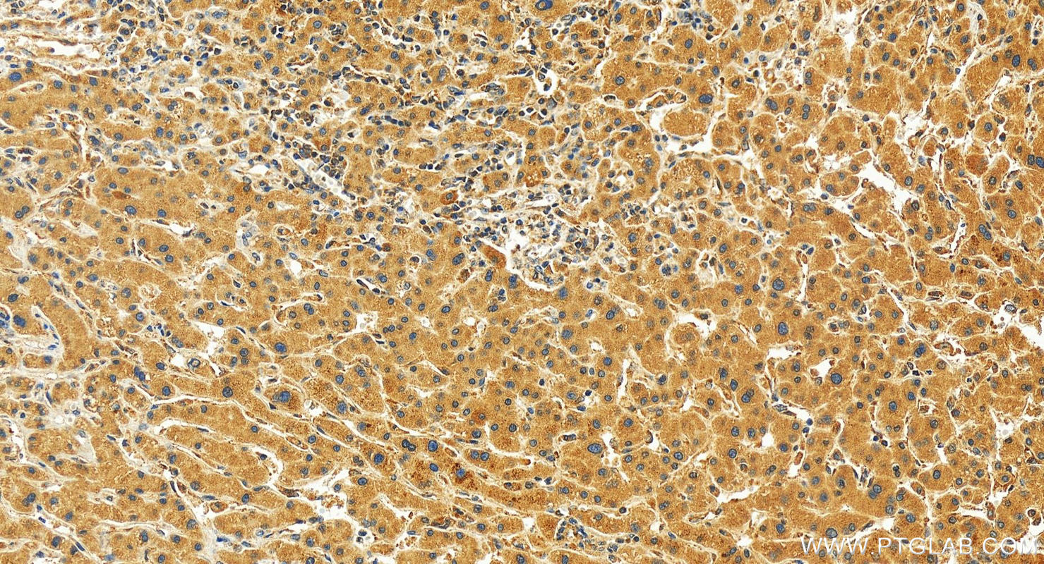 IHC staining of human intrahepatic cholangiocarcinoma using 16299-1-AP