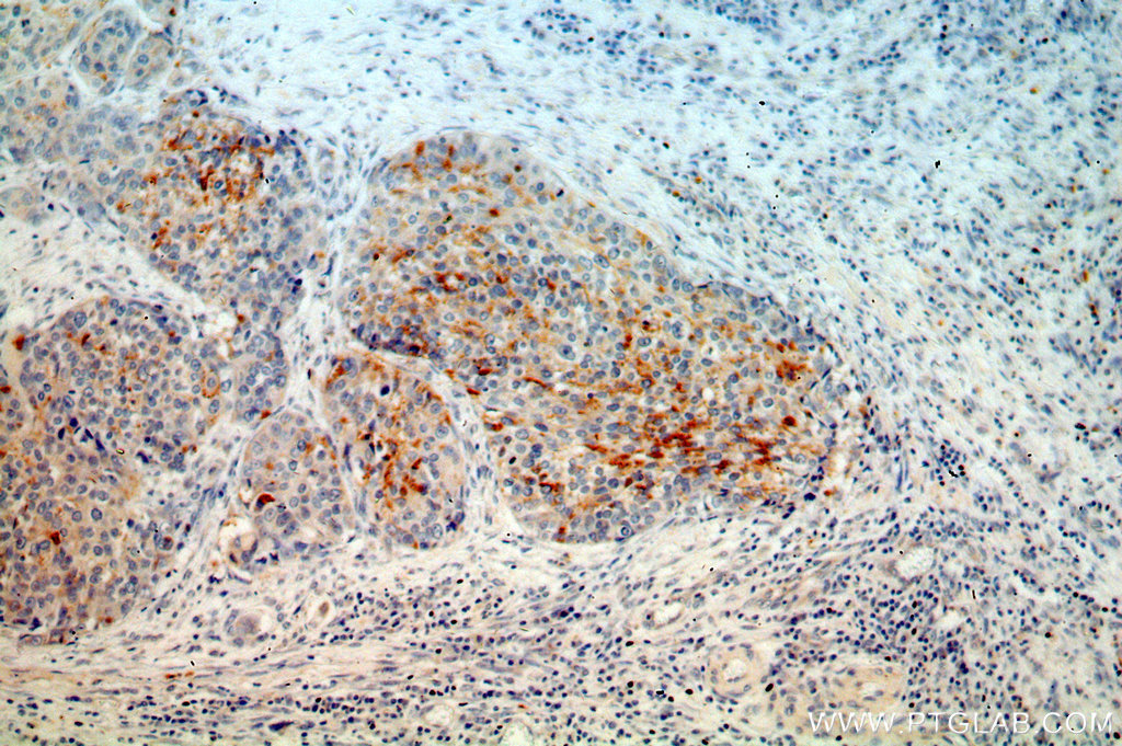 IHC staining of human cervical cancer using 16584-1-AP