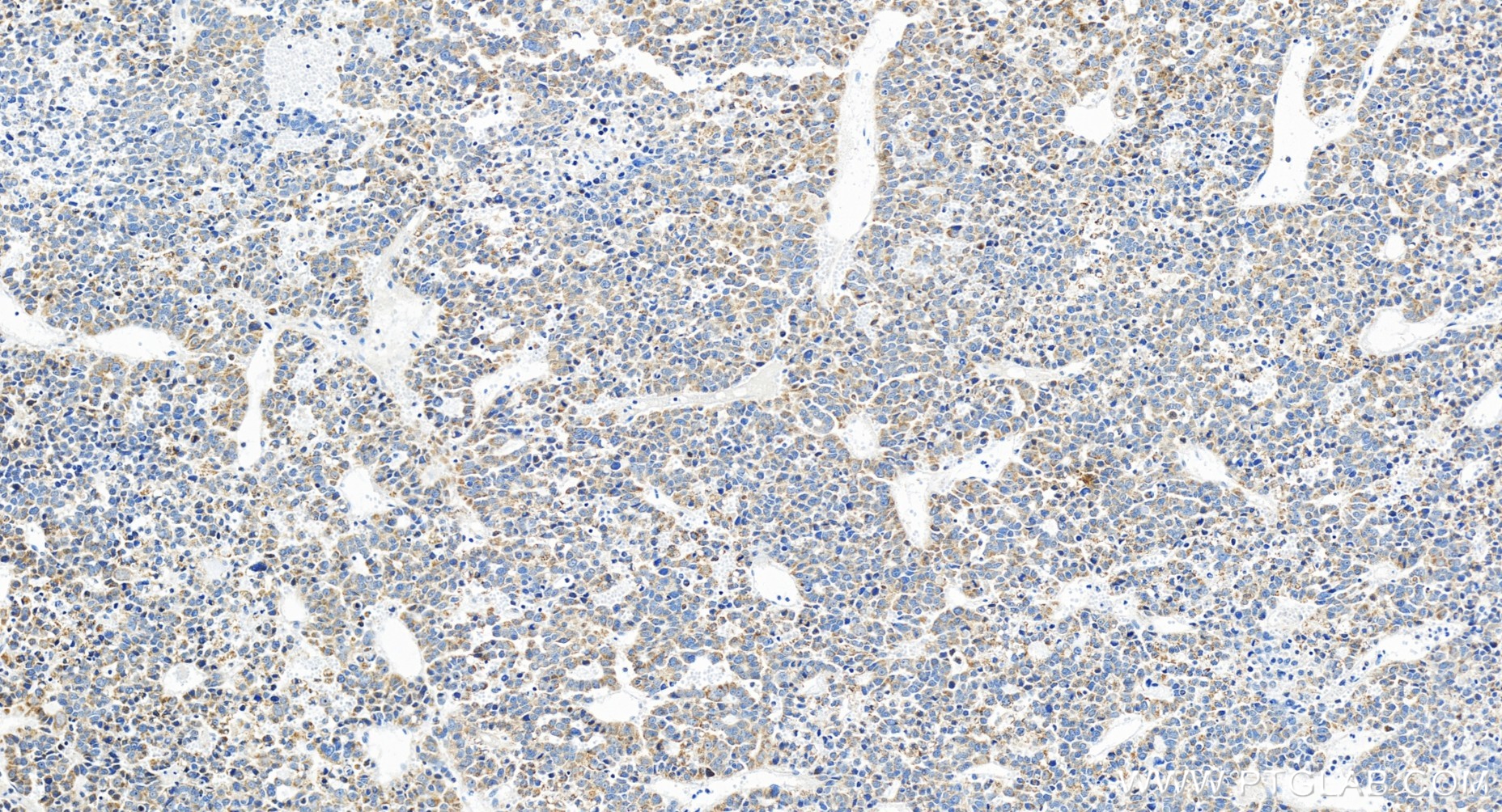 IHC staining of human liver cancer using 85327-1-RR (same clone as 85327-1-PBS)