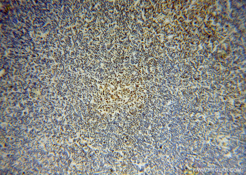 IHC staining of human lymphoma using 15190-1-AP